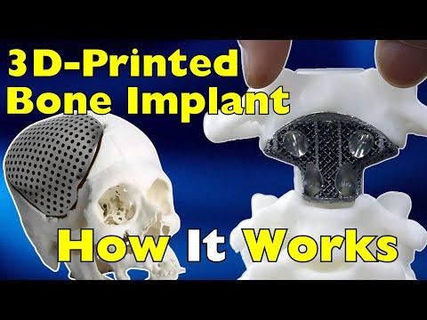 How 3D-Printed Implants Merge with the Human Body #Video
