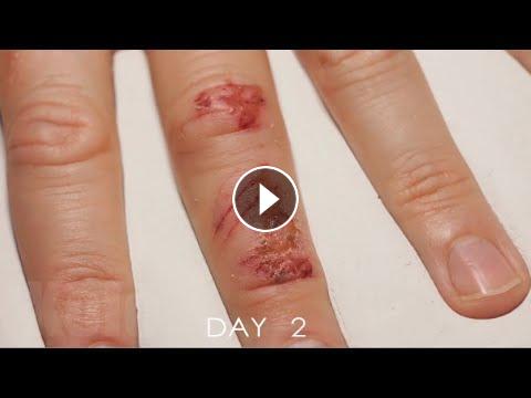 Timelapse Of A Wound Healing. Your Daily Dose Of Internet.
